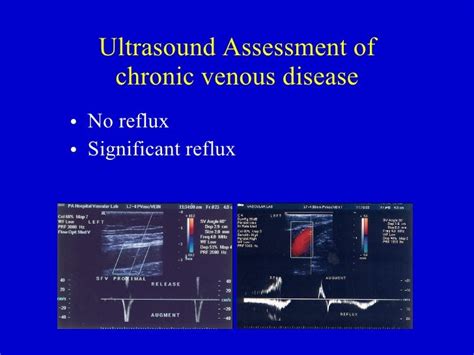 Ultrasound Assessment Of Chronic Venous Disease