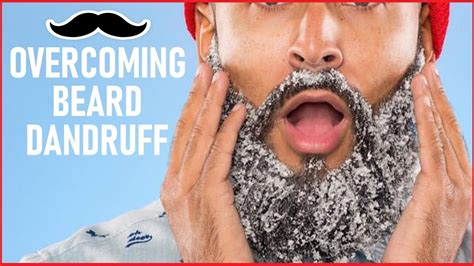 Overcoming BEARD DANDRUFF - YouTube