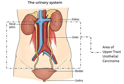 What is Upper Tract Urothelial Carcinoma (UTUC)? – Bladder Cancer Advocacy Network