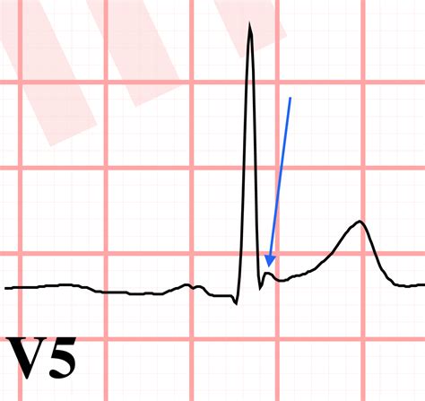 J point notching ECG