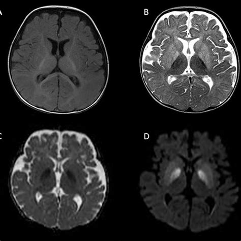 Kernicterus : MRI in a 15-day-old boy shows hyperintense globi pallidi ...