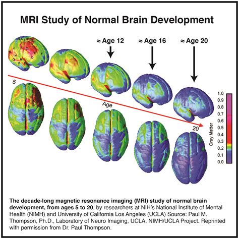 Substance Use Disorder and Brain Development | PACEsConnection