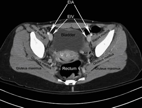 Ct Scan Anatomy Pelvis | Images and Photos finder