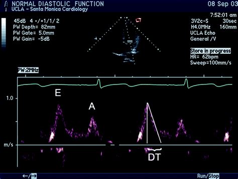 Diastolic Heart Failure: A Review and Primary Care Perspective | American Board of Family Medicine