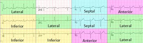 Memorizing ECG leads to heart anatomy : r/medicalschool