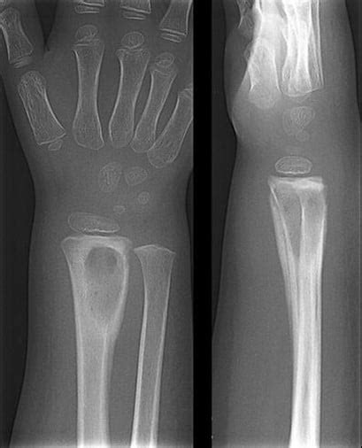 Osteomyelitis | UAMS Department of Radiology