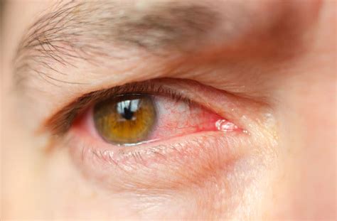 Eye infection types, symptoms and how to treat them | All About Vision