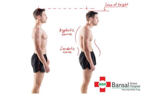 Posture and Osteoporosis - Bansal Global Hospital