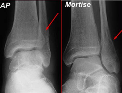 Isolated lateral malleolus fracture