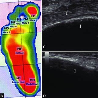 Example of RA patients with hindfoot valgus. A. Clinical aspect of the ...