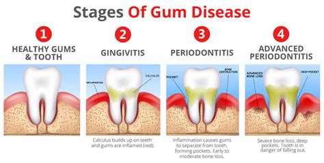 Learn About Gum Disease | Gum Infection Stages | Periodontitis Treatment