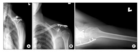 Concomitant Fracture of the Coracoid Process and the Acromion - A Case Report