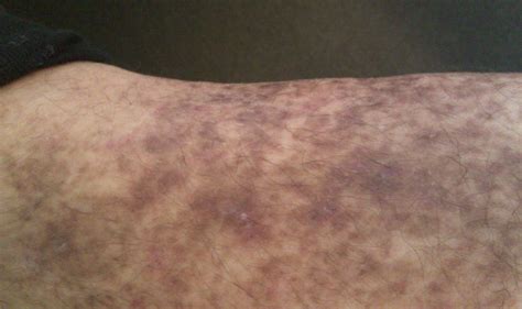 I have purple spots on my lower legs that I have been told