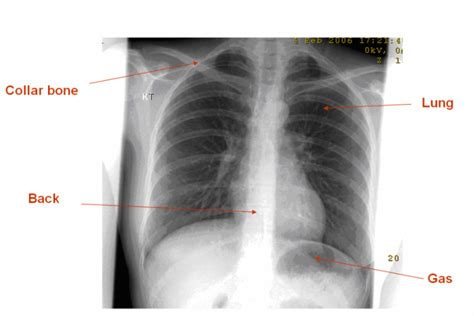 Plain Radiograph/X-ray - InsideRadiology