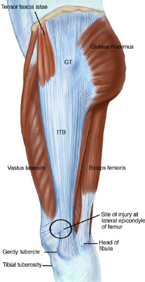 The iliotibial band and site of injury at lateral epicondyle of the ...