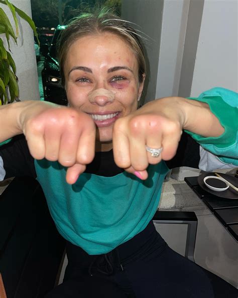 Paige VanZant's Bare Knuckles After Bare Knuckle Fighting : r/WMMA