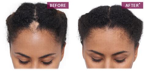 Keranique Hair Regrowth | Hair Growth Products For Women