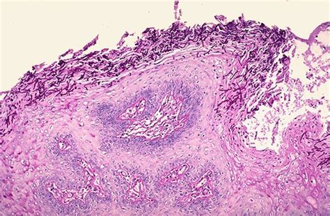 Oral Candidiasis Histology