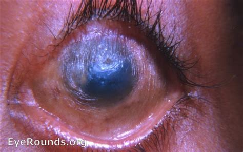 Profound xerophthalmia due to vitamin A deficiency. EyeRounds.org ...