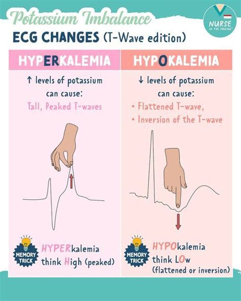 NurseInTheMaking® on Instagram: "Potassium Imbalance ECG changes (T ...