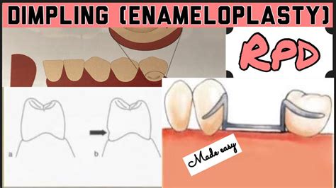 DIMPLING ENAMELOPLASTY II PROSTHETIC MOUTH PREPARATION II REMOVABLE PARTIAL DENTURE I ...