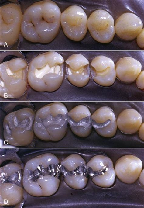 5. Dental Amalgam | Pocket Dentistry