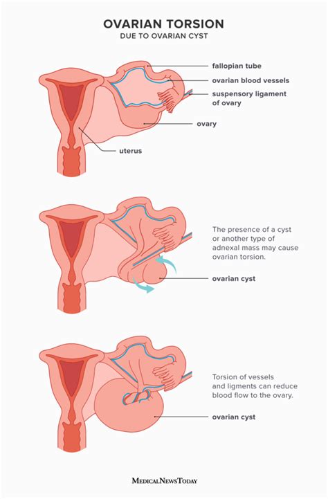 Swollen Ovaries