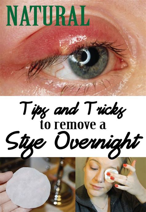 Natural Tips and Tricks to remove a Stye overnight | Eye stye remedies ...