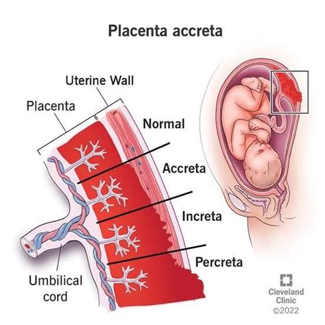 Placenta Accreta Spectrum - Bump Fitness