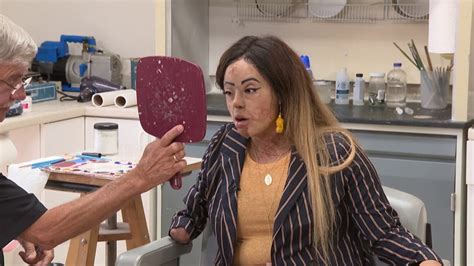 Burned in crash, Miami woman gets cutting-edge prosthetics to blend in - YouTube