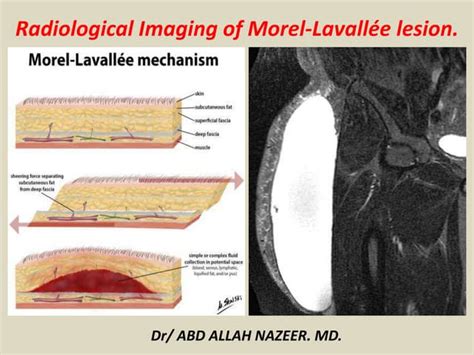 Presentation1, radiological imaging of morel lavallee lesion. | PPT