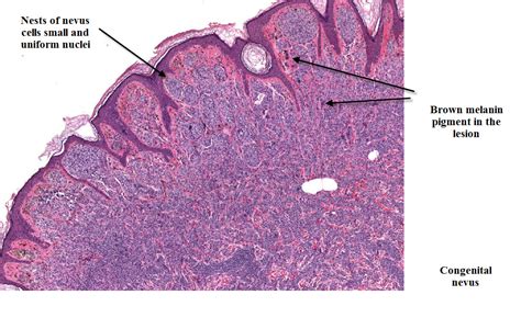 Congenital Nevus Histology