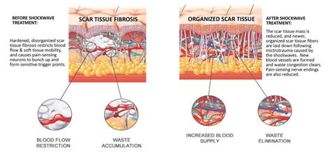 What Is Scar Tissue, and How Do I Get Rid of It? - Ask Dr. P - The Pain Doc