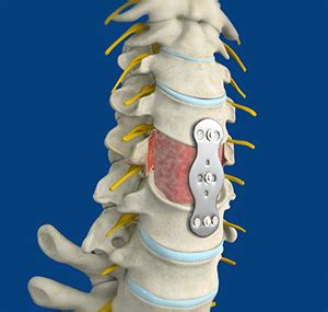 Cervical Corpectomy - Spine & Orthopedic Center