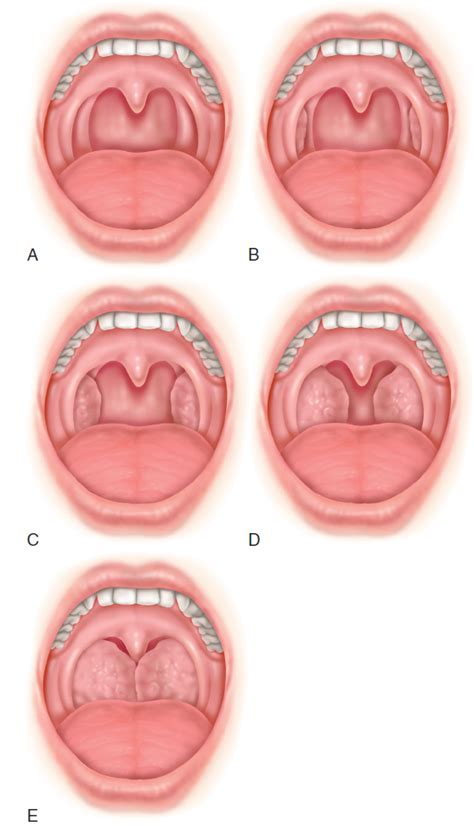 Tonsils