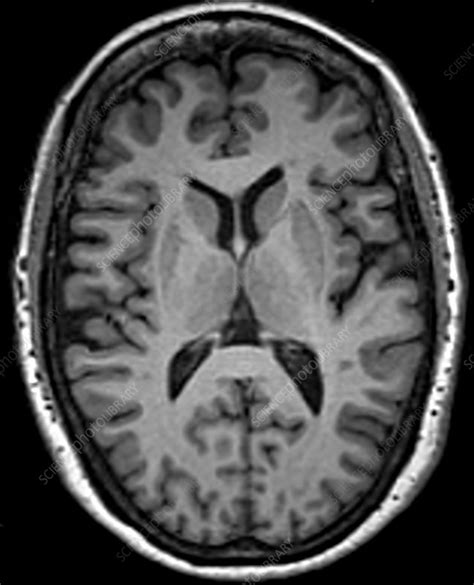 Normal MRI Scan Of Brain