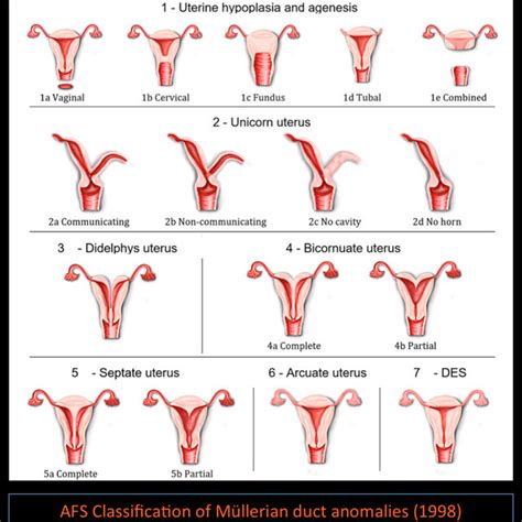 AFS Classification of Múllerian duct anomalies | Download Scientific Diagram