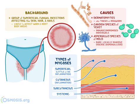 Cutaneous Mycoses: What Are They, Causes | Osmosis