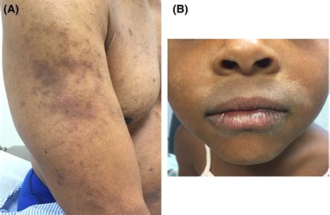 Atopic dermatitis in diverse racial and ethnic groups—Variations in epidemiology, genetics ...