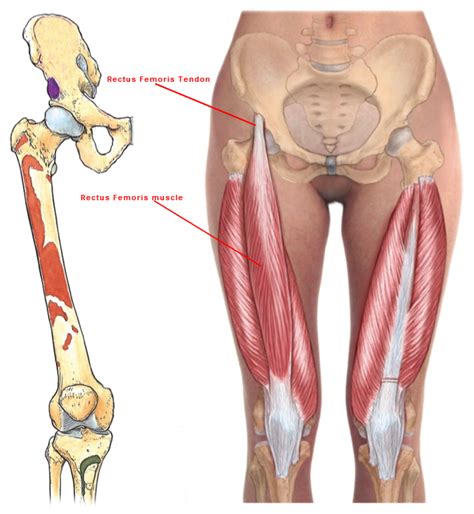 Surgical Repair of Rectus Femoris Tear - Orthopaedic Information | Singapore