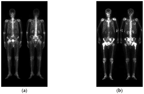 Normal Bone Scan