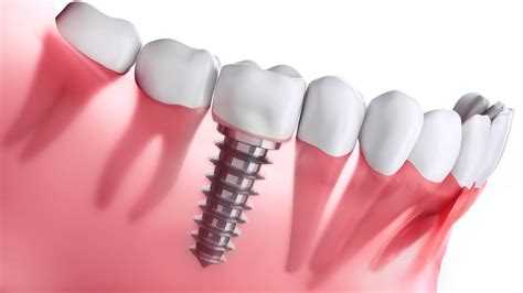 What to Expect During a Dental Implant Procedure & Its Advantages?