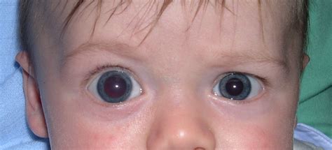 Axenfeld-Rieger syndrome: for patients - Gene Vision