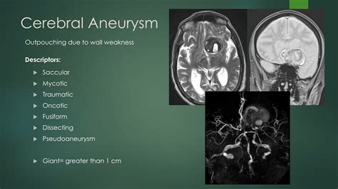 Intracranial aneurysms - YouTube