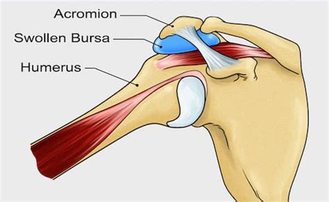 Subacromial Bursitis - Masnad Health Clinic