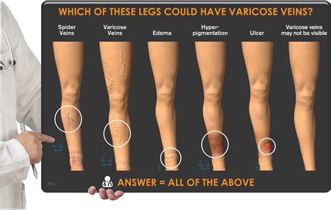 Venous Congestion Legs