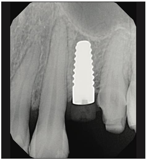 Ceramic Implants and Dental Implant Rehabilitation, Part I - Dentistry ...