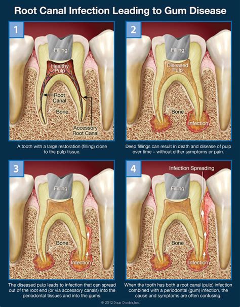 Is it a Root Canal Infection, Gum Problems, or Both?