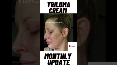 Tri Luma cream Before and After pictures - YouTube