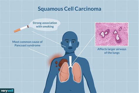 Late Squamous Cell Carcinoma